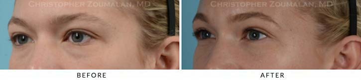 Fillers to treat lower eyelid hollowing Before & After Photo - Patient Seeing Side - Patient 7D