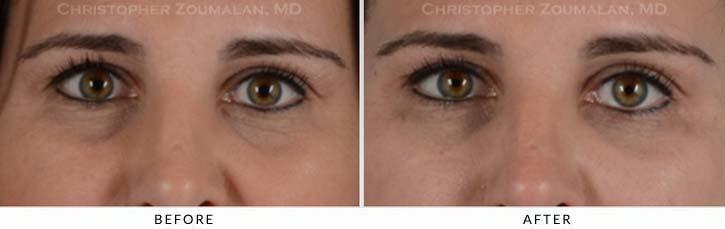 Fillers to treat lower eyelid hollowing Before & After Photo - Patient Seeing Straight - Patient 8A