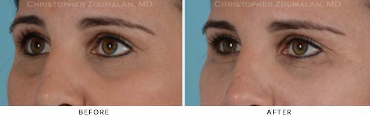 Fillers to treat lower eyelid hollowing Before & After Photo - Patient Seeing Side - Patient 8B