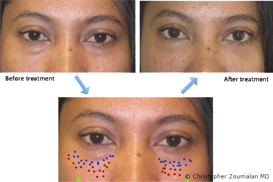 Eye Filler Real Patient Photos and What to Expect