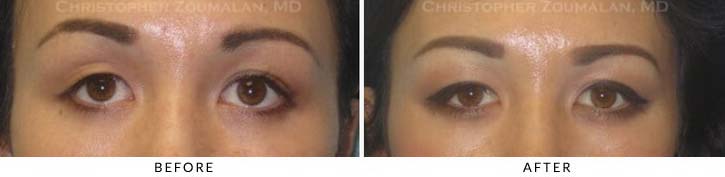 Fillers to Upper Lids Before & After Photo - Patient Seeing Straight - Patient 10