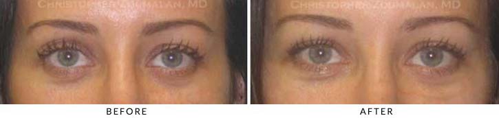 Fillers to Upper Lids Before & After Photo - Patient Seeing Straight - Patient 11