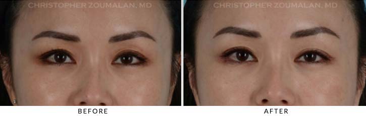 Fillers to Upper Lids Before & After Photo - Patient Seeing Straight - Patient 1A