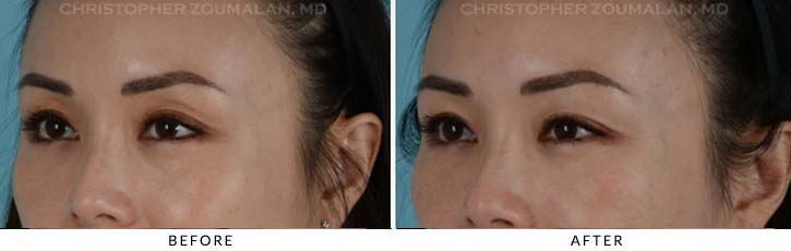 Fillers to Upper Lids Before & After Photo - Patient Seeing Side - Patient 1B