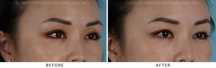 Fillers to Upper Lids Before & After Photo - Patient Seeing Side - Patient 1C