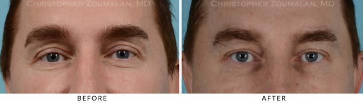 Fillers to Upper Lids Before & After Photo - Patient Seeing Straight - Patient 2A