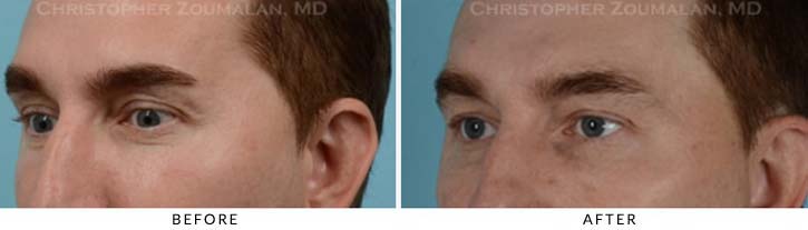 Fillers to Upper Lids Before & After Photo - Patient Seeing Side - Patient 2C