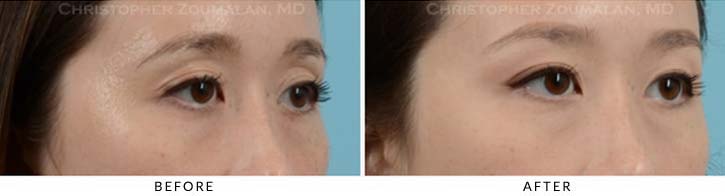 Fillers to Upper Lids Before & After Photo - Patient Seeing Side - Patient 3B