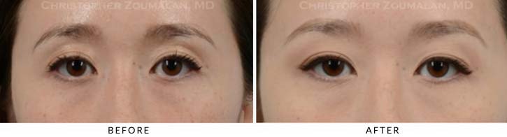 Fillers to Upper Lids Before & After Photo - Patient Seeing Straight - Patient 3C