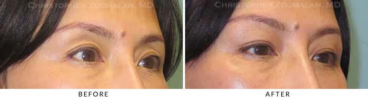 Fillers to Upper Lids Before & After Photo - Patient Seeing Side - Patient 4A