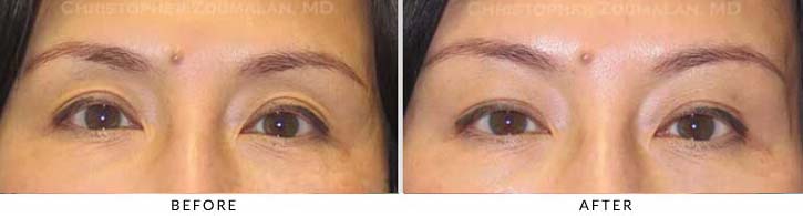 Fillers to Upper Lids Before & After Photo - Patient Seeing Straight - Patient 4B