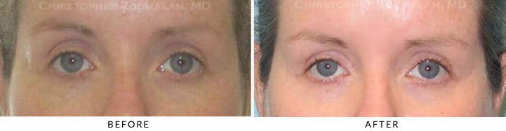 Fillers to Upper Lids Before & After Photo - Patient Seeing Straight - Patient 5