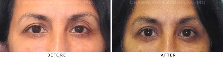 Fillers to Upper Lids Before & After Photo - Patient Seeing Straight - Patient 6