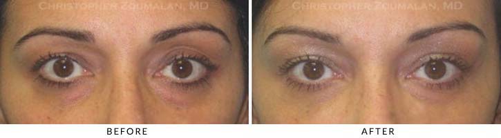 Fillers to Upper Lids Before & After Photo - Patient Seeing Straight - Patient 7