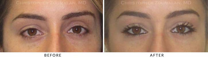 Fillers to Upper Lids Before & After Photo - Patient Seeing Straight - Patient 8