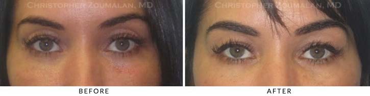 Fillers to Upper Lids Before & After Photo - Patient Seeing Straight - Patient 9