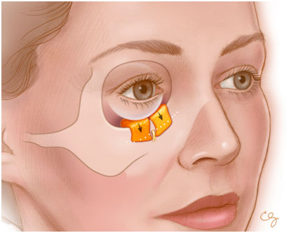 This figure shows two fat pedicles that are repositioned along the infraorbital rim to fill in the hollowing