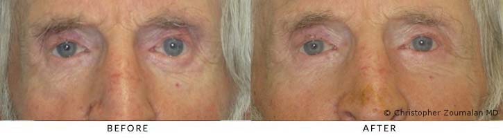 This patient had to undergo a tear duct reconstructive surgery to help his tears drain better in his left eye.