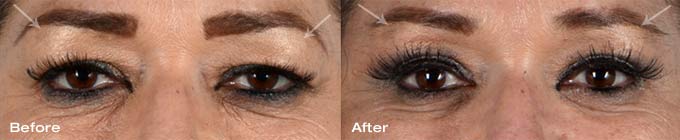 Upper eyelid blepharoplasty