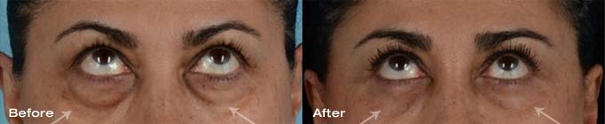 Quad Blepharoplasty