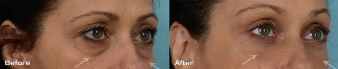 Quad Blepharoplasty