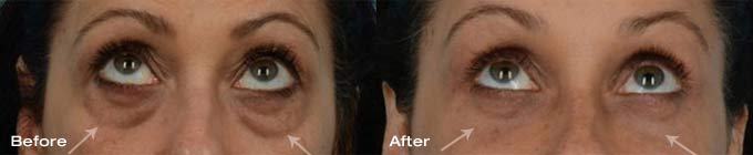 Quad Blepharoplasty