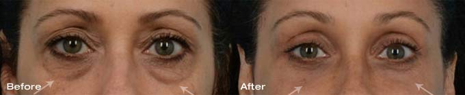 Quad Blepharoplasty