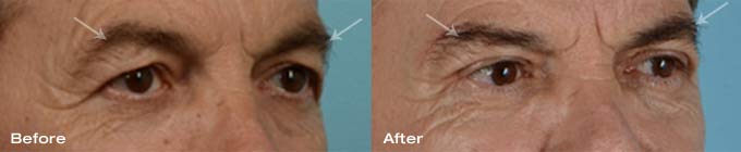 Direct Lateral Brow lift, upper eyelid blepharoplasty