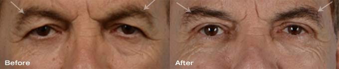 Direct Lateral Brow lift, upper eyelid blepharoplasty