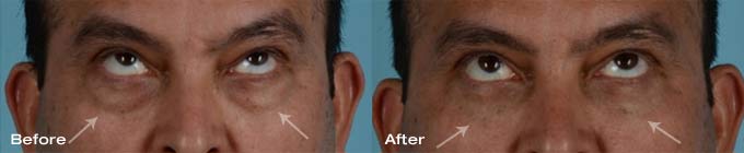 Male Quad Blepharoplasty