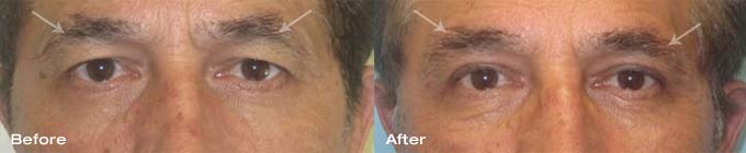 Male Blepharoplasty