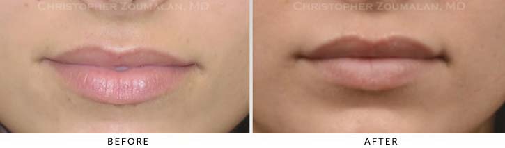 Lip augmentation Before & After Photo - Patient Seeing Straight - Patient 10
