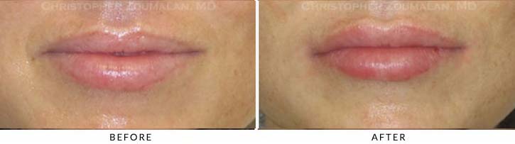 Lip augmentation Before & After Photo - Patient Seeing Straight - Patient 13