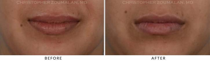 Lip augmentation Before & After Photo - Patient Seeing Straight - Patient 1A