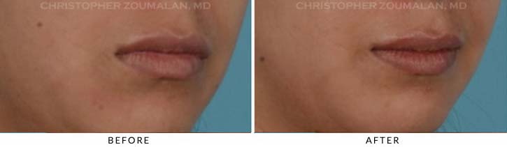 Lip augmentation Before & After Photo - Patient Seeing Side - Patient 1C