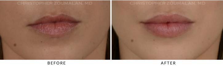 Lip augmentation Before & After Photo - Patient Seeing Straight - Patient 2A