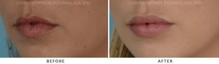 Lip augmentation Before & After Photo - Patient Seeing Side - Patient 2B