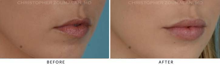 Lip augmentation Before & After Photo - Patient Seeing Side - Patient 2C