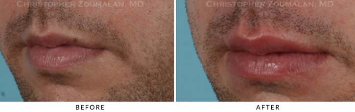 Lip augmentation Before & After Photo - Patient Seeing Side - Patient 3B
