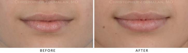 Lip augmentation Before & After Photo - Patient Seeing Straight - Patient 4A