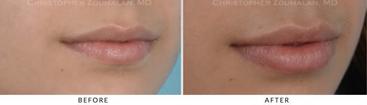 Lip augmentation Before & After Photo - Patient Seeing Side - Patient 4B