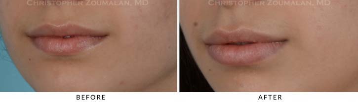 Lip augmentation Before & After Photo - Patient Seeing Side - Patient 4C