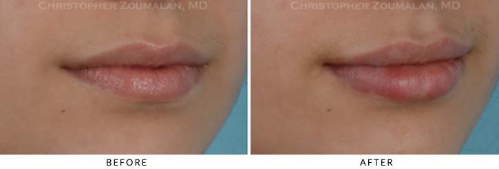 Lip augmentation Before & After Photo - Patient Seeing Side - Patient 5A