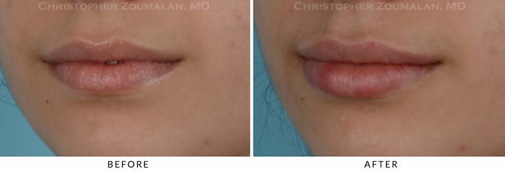 Lip augmentation Before & After Photo - Patient Seeing Side - Patient 5B