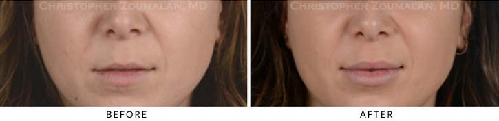 Lip augmentation Before & After Photo - Patient Seeing Straight - Patient 6