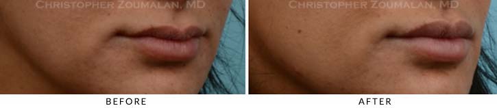 Lip augmentation Before & After Photo - Patient Seeing Side - Patient 7A