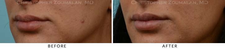 Lip augmentation Before & After Photo - Patient Seeing Side - Patient 7B