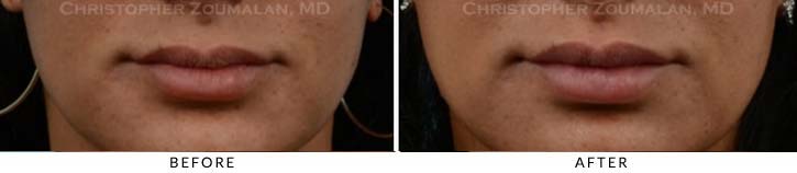 Lip augmentation Before & After Photo - Patient Seeing Straight - Patient 7C