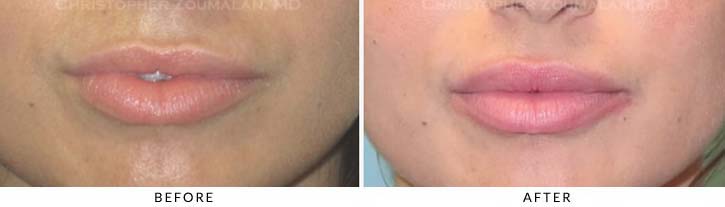 Lip augmentation Before & After Photo - Patient Seeing Straight - Patient 8