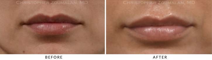 Lip augmentation Before & After Photo - Patient Seeing Straight - Patient 9